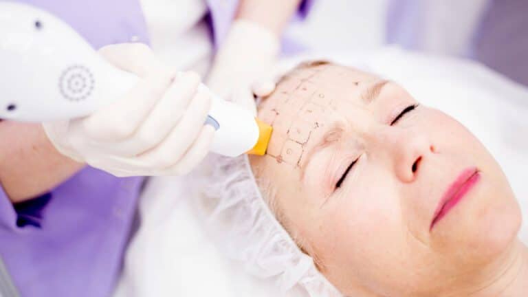 Thermage kezelés Debrecen: rádiófrekvenciás bőrfiatalítás