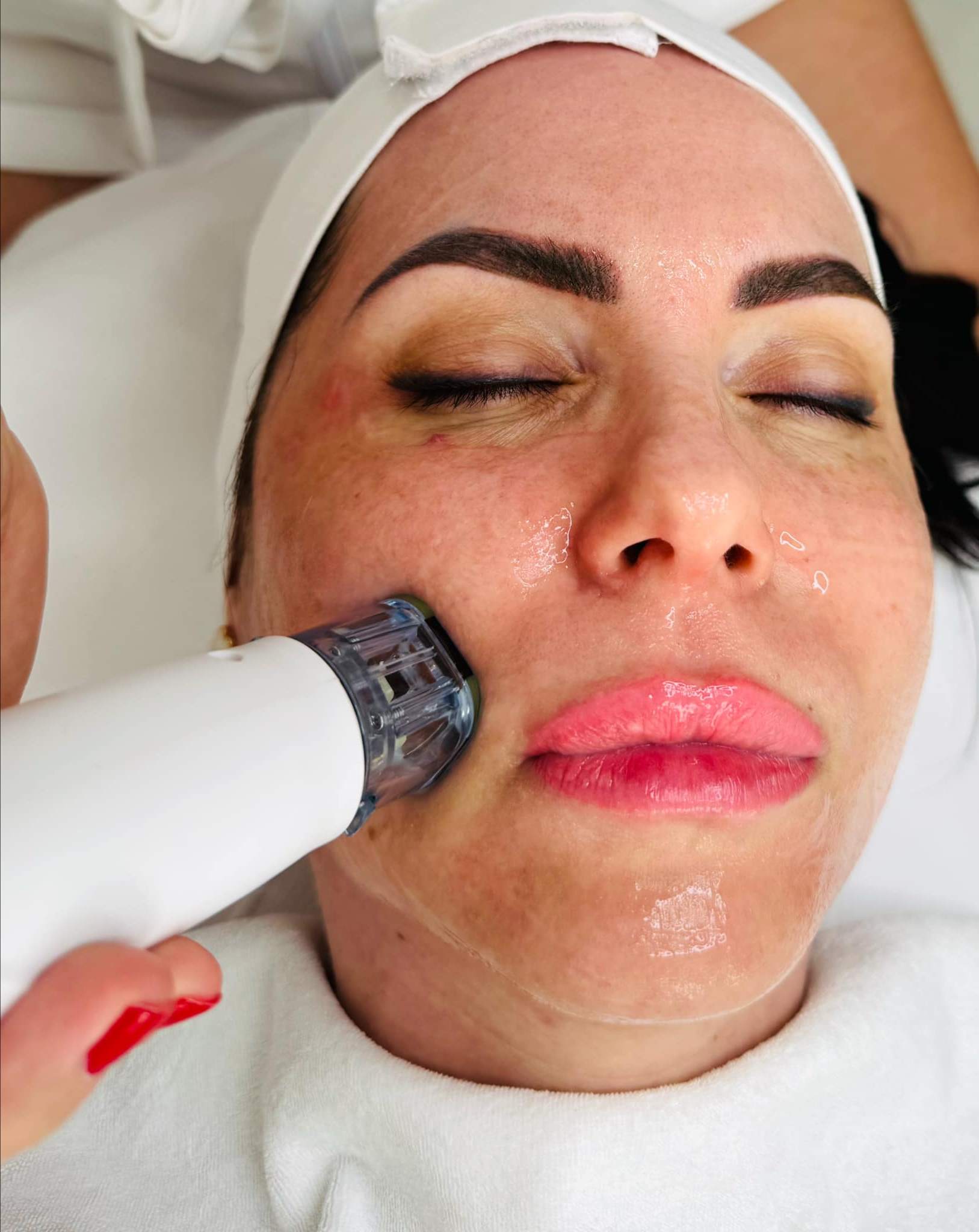 Mikrotűs rádiófrekvenciás kezelés az Apollon Beauty kozmetikai szalonban