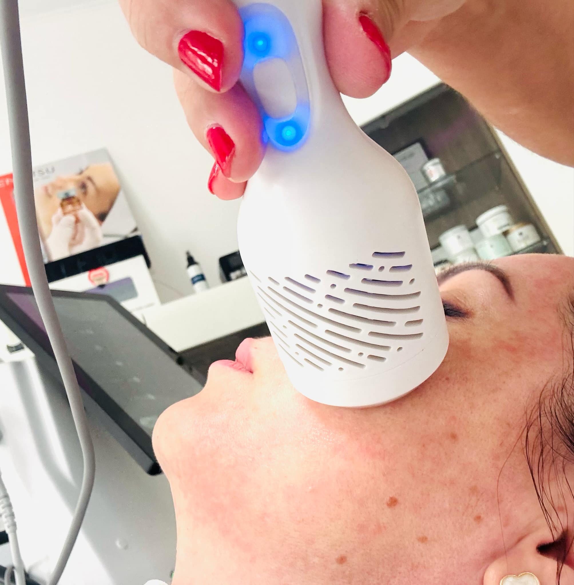 Mikrotűs rádiófrekvenciás kezelés az Apollon Beauty kozmetikai szalonban